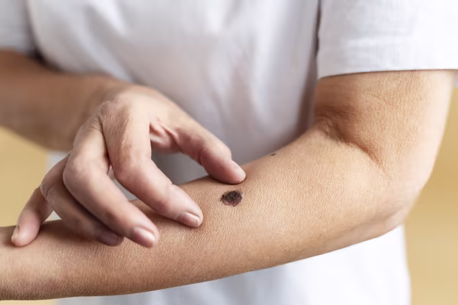Seberapa Bahayakah Kanker Kulit Melanoma